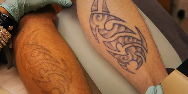 D'INKED - A TATTOO REMOVAL DOCUMENTARY: An Eye Opener